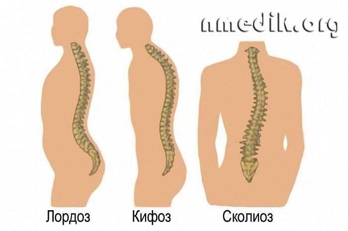 Искривление позвоночника и армия