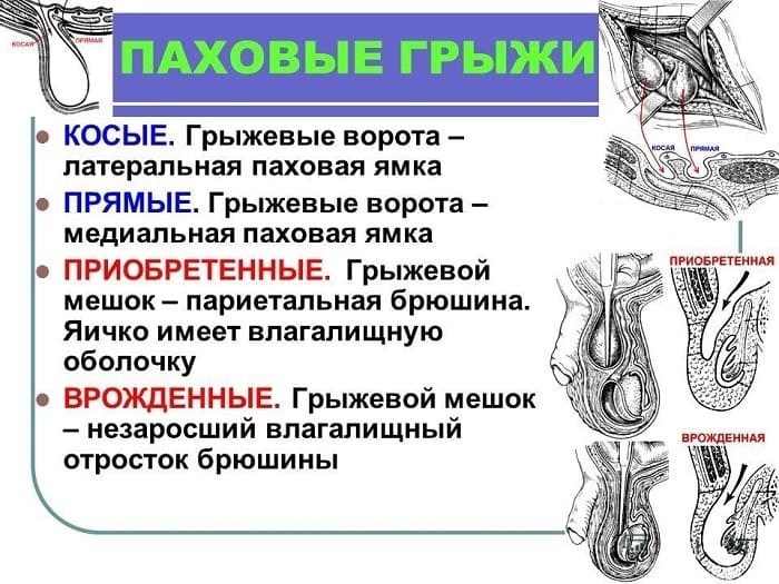 Симптомы грыжи позвоночника