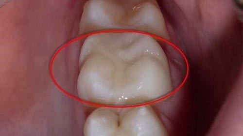 Успешное лечение зубов по ОМС
